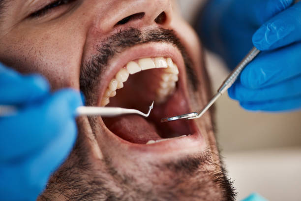 Best Emergency Wisdom Teeth Removal in Osceola, MO